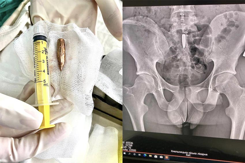 В Хмельницькому лікарі провели унікальну операцію з видалення кулі з хребта військового